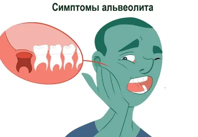 Альвеолит после удаления зуба: фото, лечение, сухая лунка | Dental Art