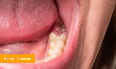Белый налет на десне после удаления зуба — что означает налет на ране в лунке  после удаления зуба мудрости?