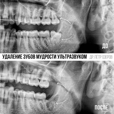 Побелела десна после удаления зуба: норма или патология - на портале  100zubov.ru