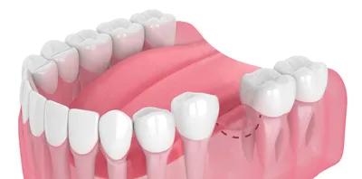 Нужно ли удалять зубы мудрости | Рекомендации стоматолога по удалению  восьмерки