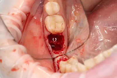 Альвеолит после удаления зуба. Цены на лечение альвеолита: фото, отзывы,  мкб 10