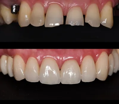 Безметалловая керамика на передний зуб — Пример работы, до и после
