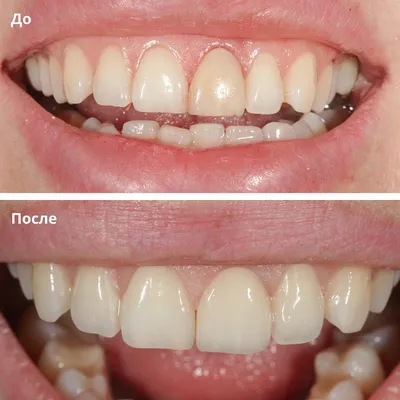 Безметалловые керамические коронки, виниры, протезы заказать недорого в  Москве - Зуботехническая лаборатория АСТРОДЕНТ
