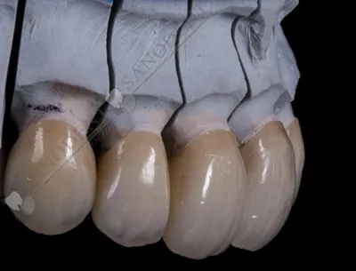 Безметалловая керамика на имплантах и своих зубах — Пример работы, фото
