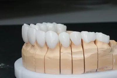 Безметалловая керамика — белое золото в стоматологии