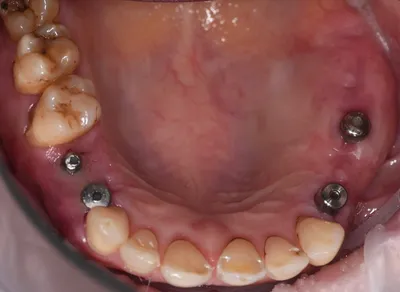 Имплантация зубов, безметалловая керамика на каркасах из циркония. —  Примеры работ — Стоматология Элита