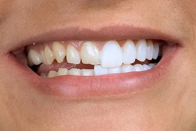 Безметалловая керамика E-max на передние зубы, фото до и после Рязань