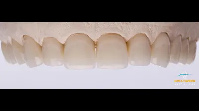 Безметалловая керамика: что это, чем отличается от металлокерамики,  технология установки керамических коронок на зубы