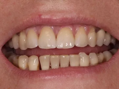 Протезирование зубов керамика (Харьков, Змиев) | Цена керамических коронок,  отзывы пациентов, результаты «до и после» | Verno - цифровая стоматология