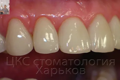 ① Керамические коронки на зубы Киев ᐉ Безметалловая керамика - цена в RISU