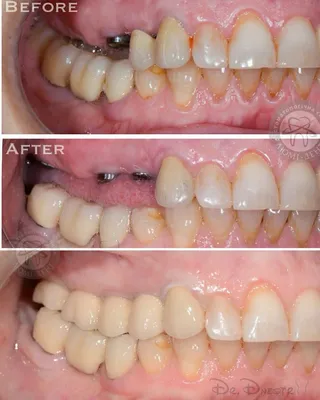 Безметалловые коронки в Москве по доступной цене | Atlantis Dental