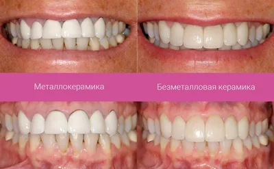 Безметалловые коронки на передние зубы: фото до и после | Киостом