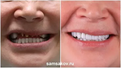 Керамические коронки на зубы дисиликат лития E.MAX