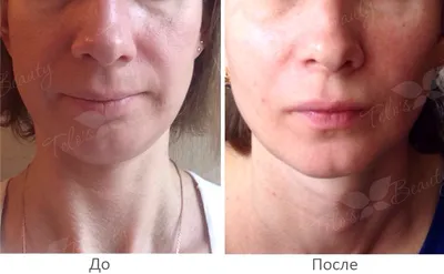 Биоармирование лица: цены в Москве