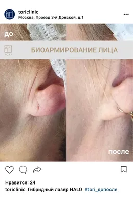 Биоармирование лица| Цены на лифтинг кожи в Москве