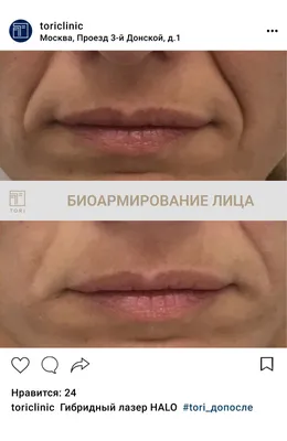 Радиесс - биоармирование в Москве, цена, сделать радиесс - биоармирование