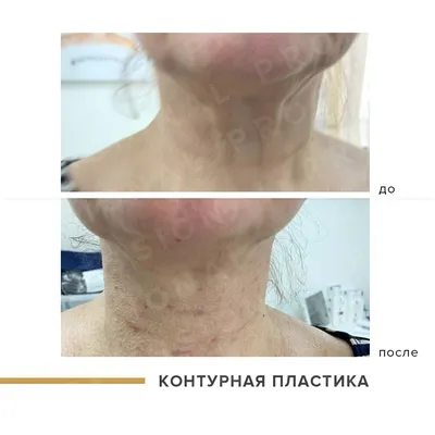 Биоармирование