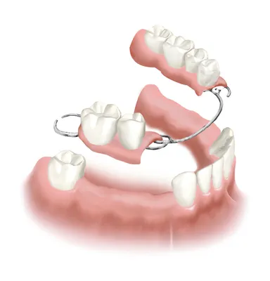 Односторонний бюгельный протез на нижнюю челюсть