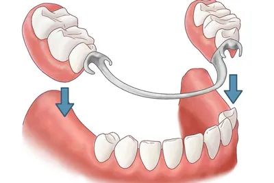 Бюгельный протез: плюсы, виды, почему именно он? — Статьи стоматологии  Династия-С