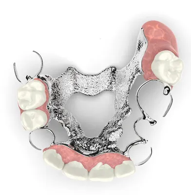 Бюгельный съемный протез на кламмерной фиксации. -