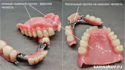 Бюгельный протез зубов | цена на верхнюю и нижнюю челюсть в Ставрополе