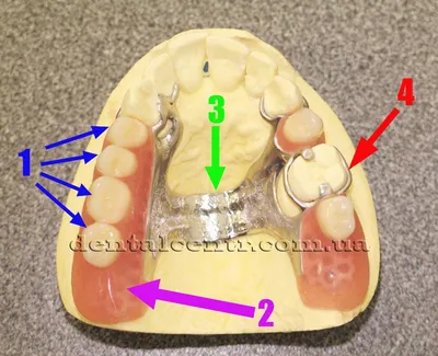 Бюгельные зубные протезы заказать изготовление в Москве - зуботехническая  лаборатория «АстэраЛаб»
