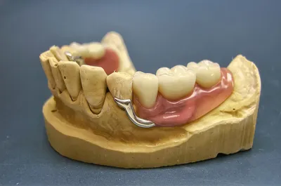 Частично съемный протез на нижнюю челюсть. Услуги установки частичного  съемного протеза на нижнюю челюсть. Установка частичного съемного протеза  на нижнюю челюсть в Москве.