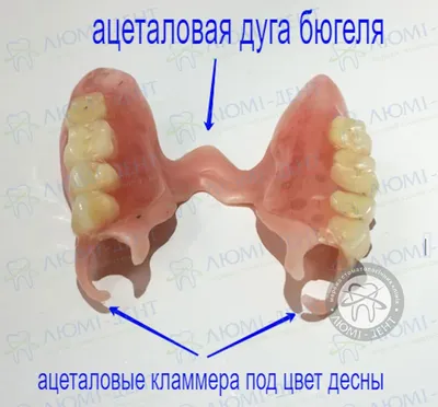 Бюгельный протез зубов – цена на верхнюю и нижнюю челюсть, фото, отзывы