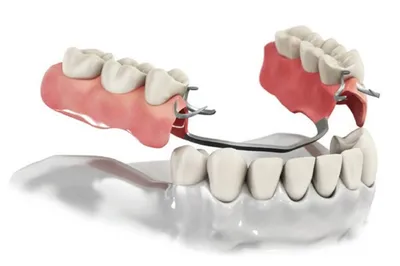 Протезирование бюгельным протезом замковой системой фиксации в  Ростове-на-Дону - МаэстроДент