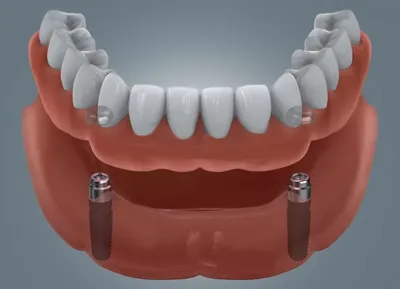 Бюгельный протез на верхнюю челюсть в Москве, цены в стоматологии АО  Медицина