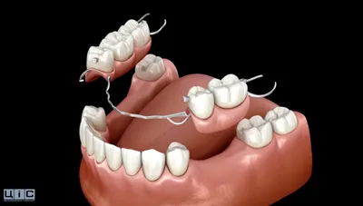 Бюгельные протезы Мытищи, бюгельные протезы зубов Мытищи
