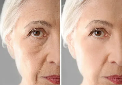 Бланширование лица фото до и после фотографии
