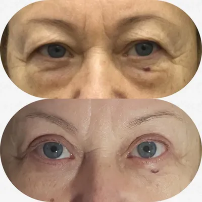 https://www.visus-novus.ru/info/pacient/blefaroplastika/