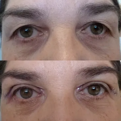 Бефаропластика лица и глаз: как убрать нависшее веко и мешки под глазами