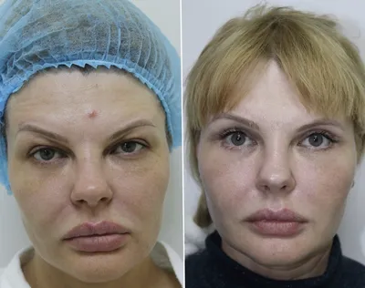 Круговая блефаропластика в Москве, фото до и после операции