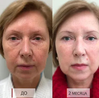 https://www.visus-novus.ru/info/pacient/blefaroplastika/