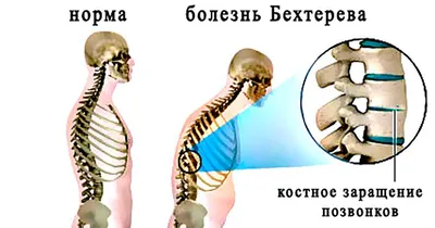 Болезнь Бехтерева - причины, симптомы, диагностика и лечение