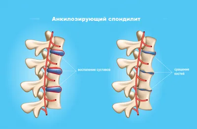 Болезнь Бехтерева: симптомы, стоимость лечения препаратами и ЛФК, причины,  диагностика