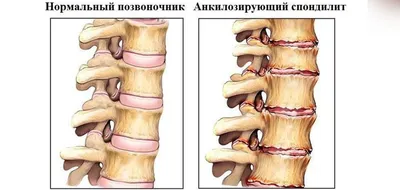 Анкилозирующий спондилит (Болезнь Бехтерева) || Объединенная больница с  поликлиникой (ОБП) Управления делами Президента РФ