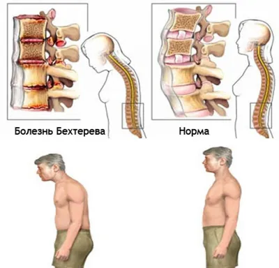 Болезнь Бехтерева: причины, симптомы, лечение | Клиника Эксперт