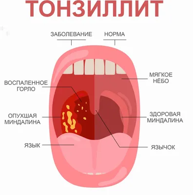 Как узнать состояние горла: экспертный комментарий