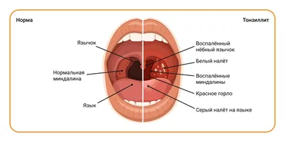 Болезни горла: виды и причины, хронические и инфекционные заболевания  горла, симптомы, читайте в статье блога Furasol®
