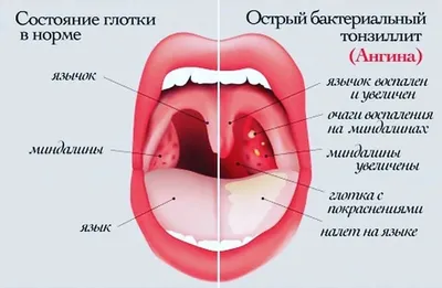 Часто болит горло: причины и способы лечения