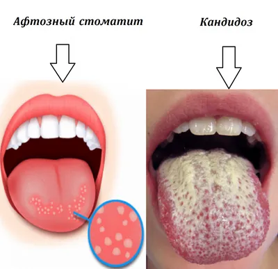 Географическая Болезнь Языка У Кавказского Ребенка — стоковые фотографии и  другие картинки Язык - орган тела - Язык - орган тела, Гореть, Ребёнок -  iStock