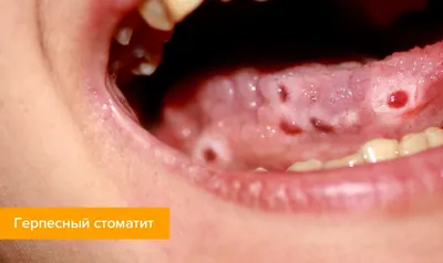 анимация рта и языка, картинка горла при стрептококке фон картинки и Фото  для бесплатной загрузки