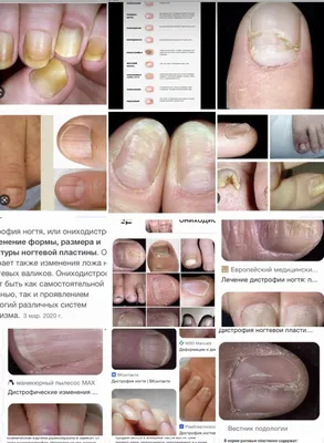 Самые распространенные заболевания ногтей от гель лака. | Лялина Екатерина  | Дзен