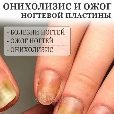 Желтые ногти - причины появления, симптомы заболевания, диагностика и  способы лечения