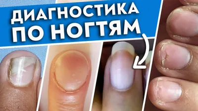 СИМПТОМЫ БОЛЕЗНЕЙ НОГТЕЙ Поражения ногтей при разных заболеваниях часто  похожи. Это объясняется тем, что.. | ВКонтакте