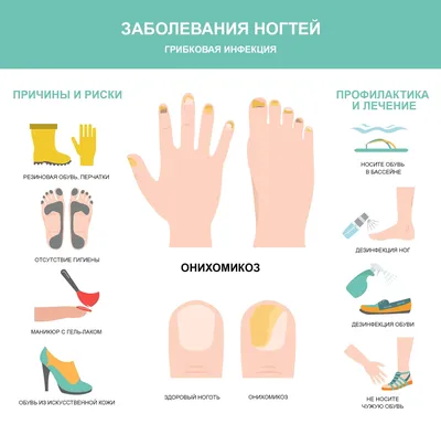 Грибковые болезни на ногах руках и ногтях