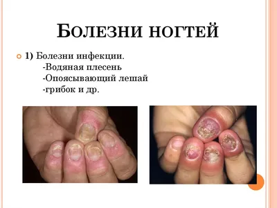 Kasya Nail Club - ➕если интересно @nail_manicure_kasya вебинар 3 в 1 Болезни  ногтей+ожог и онихолизис👌 Самые распространенные проблемы, которые волнуют  всех мастеров😱 на нашем вебинаре👇 @nail_manicure_kasya 📌 Болезни ногтей:  с какими ногтями
